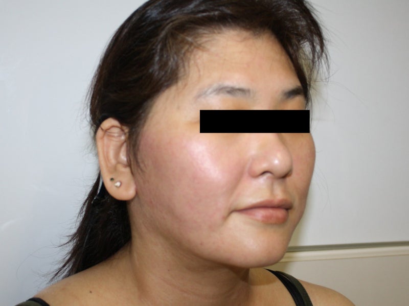 【術後3ヶ月】46歳女性のフェイスリフト+頬・アゴ下脂肪吸引 3 シンシア～Sincerely Yours 銀座の美容外科・美容皮膚科（くま治療）