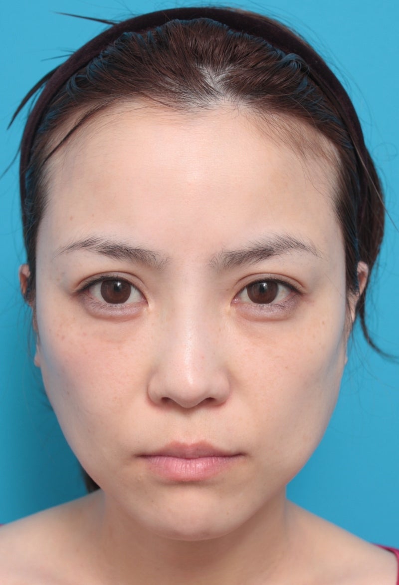 30代女性に行った金の糸症例写真アップ！ 美容整形高須クリニック 高須 幹弥 オフィシャルブログ