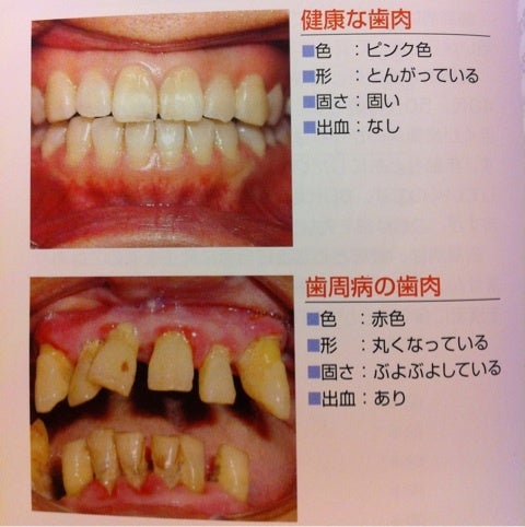 健康 な 歯茎 比較