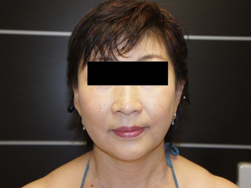 55歳女性 フェイスリフト+頬アゴ下脂肪吸引+ほうれい線脂注2（4か月） シンシア～Sincerely Yours 銀座の美容外科・美容
