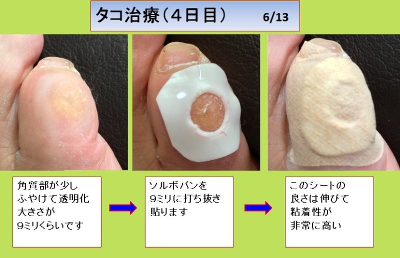 足 の 小指 の タコ 治療