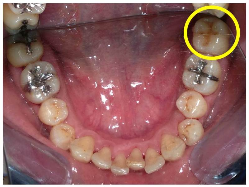 歯 の 詰め物 取れ た 放置