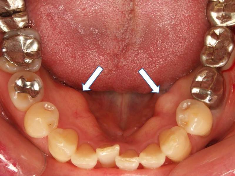 歯 の 内側 歯茎 腫れ