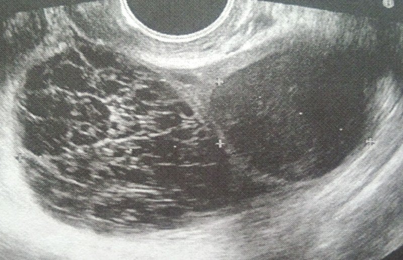 黄体 化 未 破裂 卵胞 妊娠 した ブログ