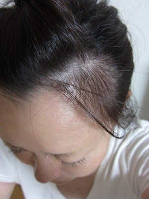 私が気になる薄毛は、前髪あたりおでこの生え際部分です。 | 30代・40代 アラフォー女の前髪・頭頂部の薄毛対策 育毛剤・サプリ・シャンプー