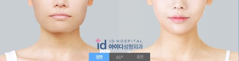 ID美容外科、ミニVライン、韓国輪郭、小顔