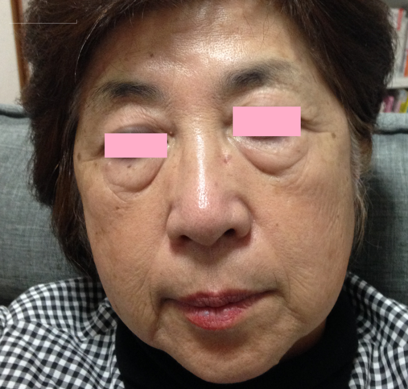 耳つぼ リフトアップの効果2 65歳女性 はりきゅうマッサージ ふわ丸のブログ