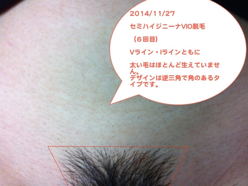 VIO脱毛（アンダーヘア）の形について：写真付｜『全く痛くない脱毛』ムダ毛の悩み解消します！名古屋市の脱毛専門店スキン