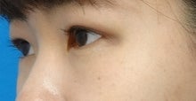 二重埋没法NQ10