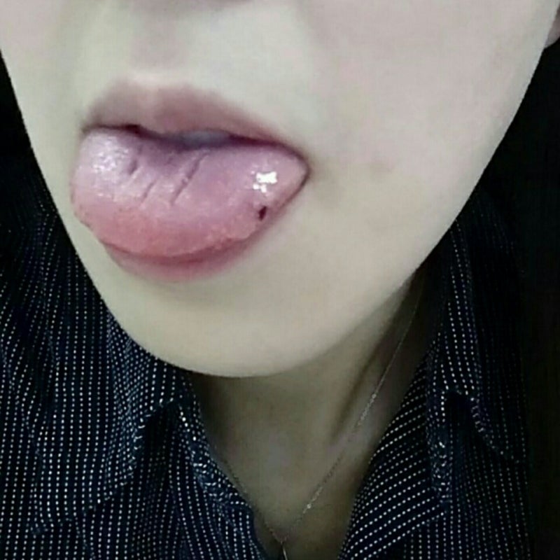 舌 に 血豆