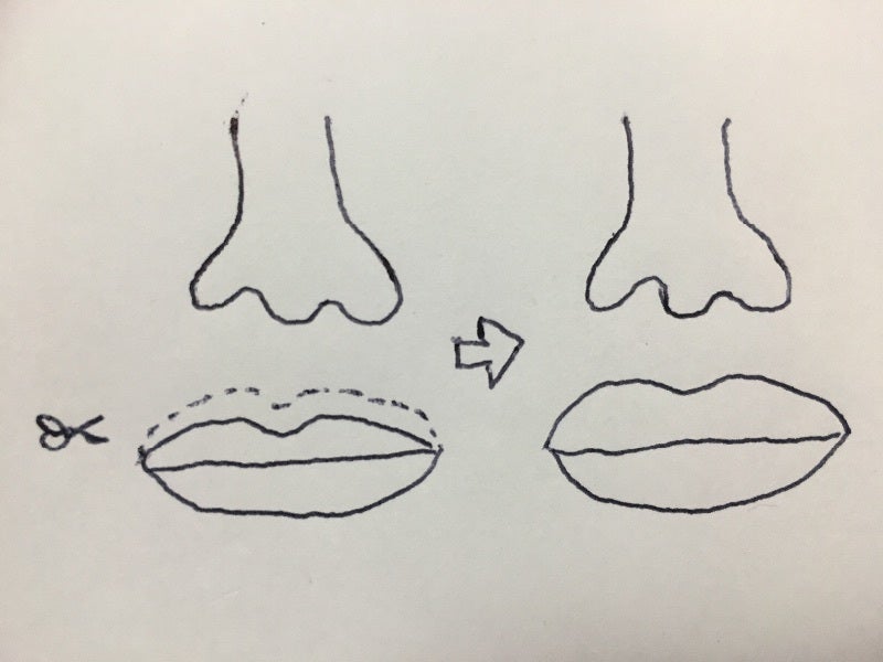 鼻の下を短くする整形手術② 人中短縮と口角挙上の美容整形ブログ