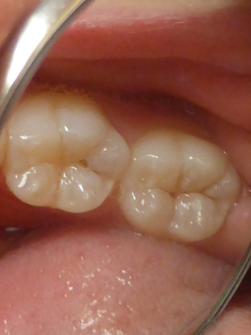 奥歯 乳歯 の まま