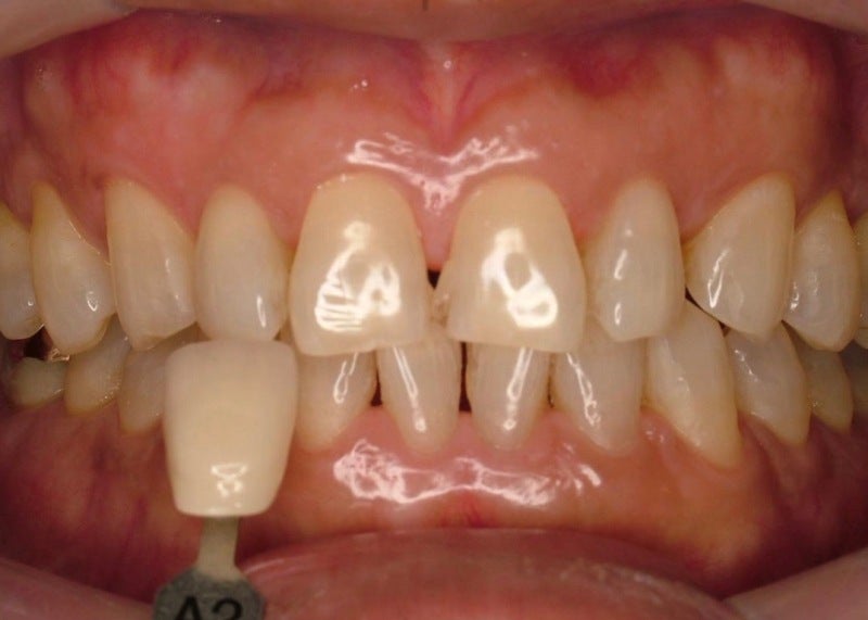 加 齢 による 歯 の 黄ばみ ホワイトニング