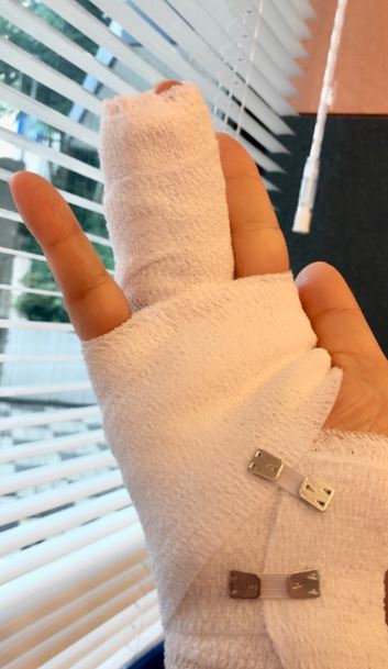秋吉久美子、右手の薬指を骨折「入院したい、、。」