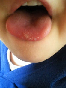 先端 痛い 舌