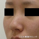 鼻シリコンプロテーゼ　症例写真　レントゲンの必要性の記事より