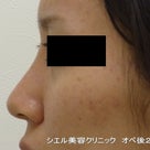 鼻シリコンプロテーゼ　症例写真　レントゲンの必要性の記事より