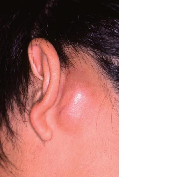 60 09 18 歳 男性 5 年ほど前より 左耳後部の皮下腫瘤が出現した 皮膚科専門医試験勉強されている方 皮膚病 皮膚に関心のある方のためのブログ