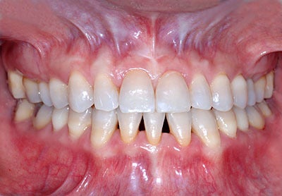 １度治した虫歯は２度と虫歯にならないアメリカ最新歯科治療