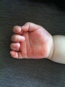 [最も欲しかった] 赤ちゃん 手のひら 汗疱 279483赤ちゃん 手のひら 汗疱