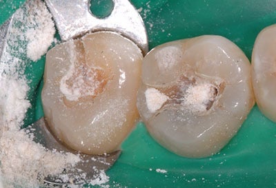 顎関節症 歯科治療 ラストホープ 証明 画像症例集 GVBDO-04100911