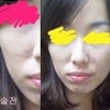 <韓国整形外科、プロポーズ>　脂肪移植の後記の画像
