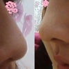 <韓国整形外科、プロポーズ>　鼻の手術して2ヶ月後～の画像