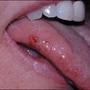 舌咬傷の見方　～一過性意識障害の鑑別～の画像