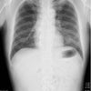 敗血症性肺塞栓症(septic pulmonary embolism)の画像