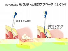 Advantage Fit を用いたTVT手術の評価 女性泌尿器科医 竹山政美のブログ