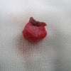 粉瘤（follicular cyst）の画像