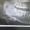 今回の歯の治療は、ここからでした(T_T)の画像