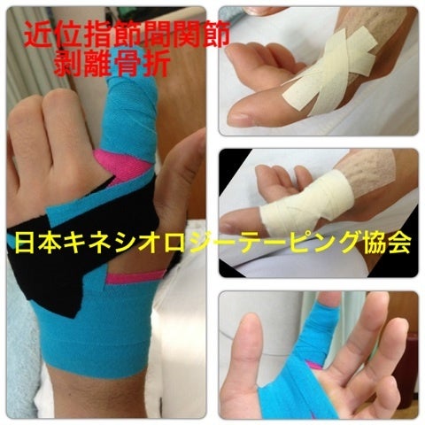指の剥離骨折のテーピング かがみ院長のブログ