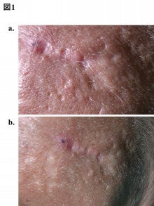 ダーマローラーのざ瘡後瘢痕に対する効果 基礎研究 Besselwegのブログ