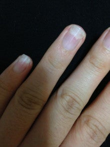 爪が皮膚から剥がれる 爪甲剥離症とは 静岡 痛くない 巻き爪 補正