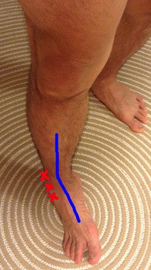 足首のケガで膝と太ももに影響 豊洲カイロプラクティック 江東区豊洲のカイロ 整体 のブログ
