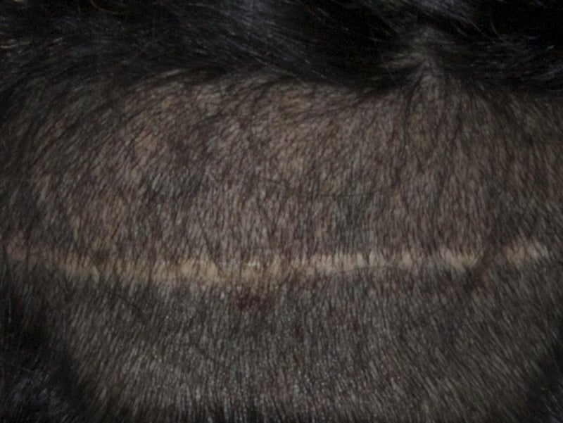 ACELL細胞外治療をアルタス自毛植毛のオプションとして開始しましたの記事より