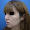 鼻を高く(SBCソフトプロテーゼ法)　の画像