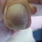 ペディグラス陥入爪の補正コースをマンツーマンで開催しましたの記事より