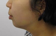 顎のたるみを解消してアゴのラインをスッキリ 美顔トレーニング 吉成聡のブログ