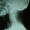 レントゲン分析～腰痛・坐骨神経痛～の画像