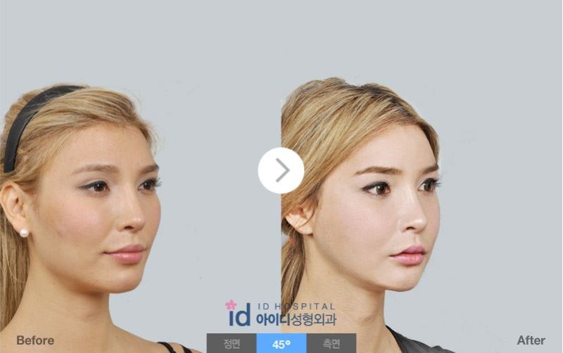 韓国整形、エラ削り、頬骨縮小術、輪郭手術