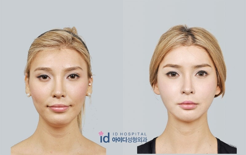 韓国整形、エラ削り、頬骨縮小術、輪郭手術