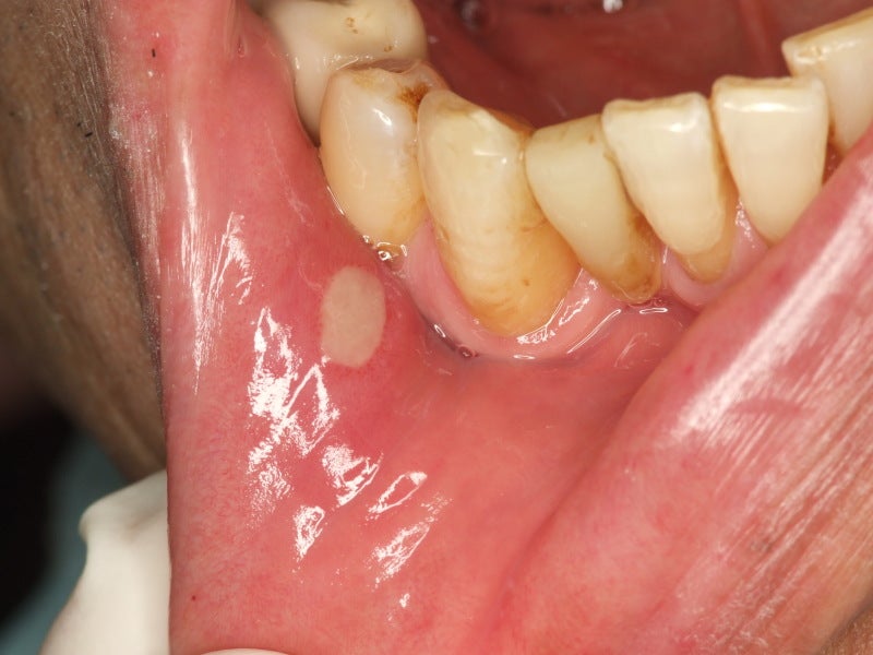 典型的な口内炎『アフタ性口内炎』 | 東京・神田、日本橋で審美歯科、矯正歯科、精密根管治療、インプラント治療なら「神田デンタルケアクリニック」