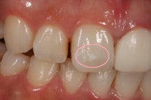 歯の表面の白い模様 佐賀の歯医者のブログ