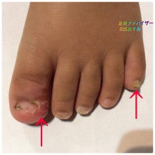 子どもの足のつめが折れたり割れたりするときは 靴のサイズを チェックしましょう 足育アドバイザー 保育士 成田あす香のブログ