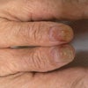 爪の変形の画像