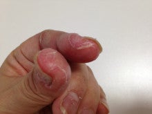 指の皮がむける 指の皮がむける 刺激性接触性皮膚炎