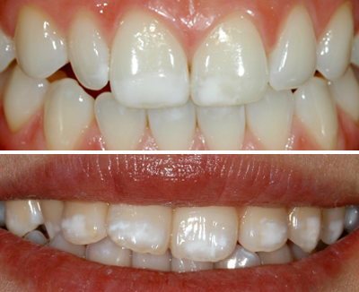 歯の白い斑点 ホワイトスポット の治療方法 Hushu