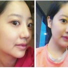 ID美容外科での両顎手術(受け口、非対称）＋Vライン手術(韓国輪郭。韓国整形）の記事より